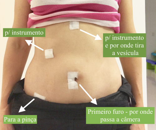 cirurgia de vesicula