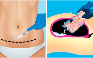 Cesárea: confira todos os detalhes dessa cirurgia
