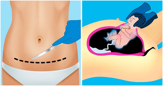 Cesárea: confira todos os detalhes dessa cirurgia